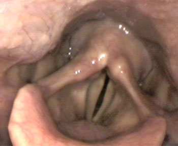 Paralysed left vocal cord resulting in weak breathy voice