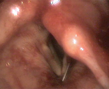 Needle being advanced towards the paralysed vocal cord to inject the filler