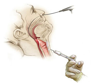 Trans-cricothyroid injection procedure